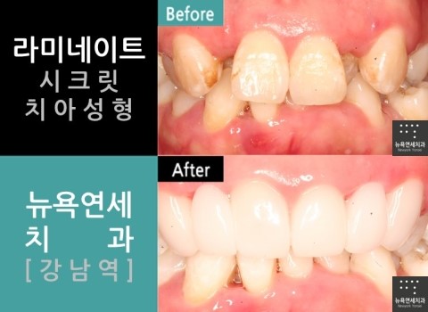  [강남역치과 덧니라미네이트] 잘하는곳