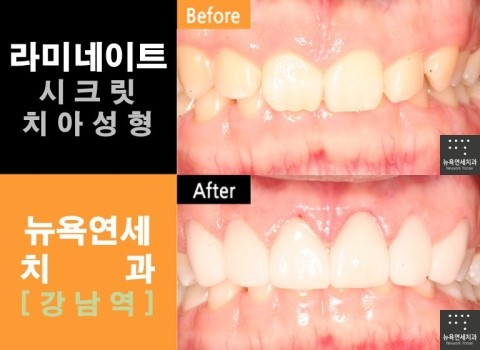  라미네이트 라미네이트잘하는곳*라미네이트전문