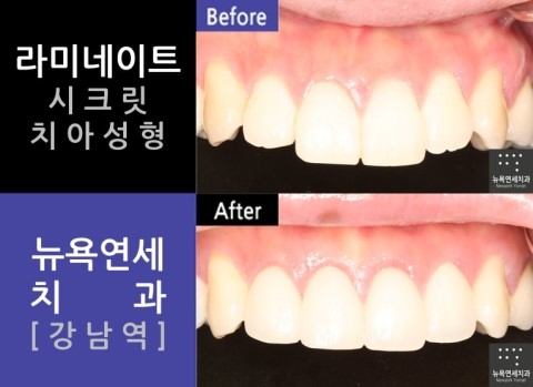  [뉴욕연세치과] 치아성형 전문치과 _ 앞니치아성형 전후