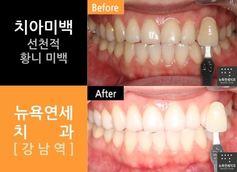  치아미백 치아미백잘하는곳＊치아미백치과