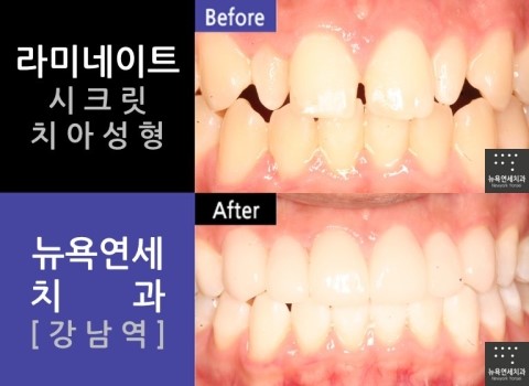  [강남역치과*라미네이트] 라미네이트잘하는곳_뉴욕연세치과