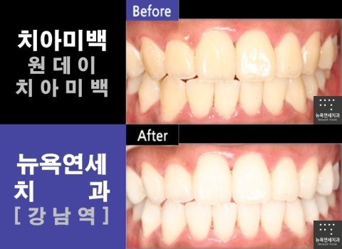  [강남역치과] 원데이 치아미백 * 치아미백 잘하는곳