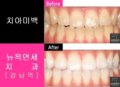  [강남역치과 치아미백] 줌미백 잘하는곳_치아미백 전후사진