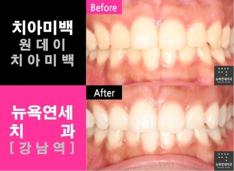  치아미백 원데이치아미백 * 원데이줌미백_뉴욕연세치과