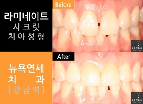  [라미네이트] 강남역치과 라미네이트_치아성형 잘하는곳