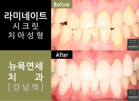 강남역치과 치아성형 전문