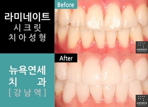  강남역치과 라미네이트가격합리적인라미네이트비용뉴욕연세치과