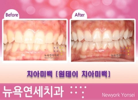  [강남역치과] 원데이치아미백 전문치과_치아미백 전후사진