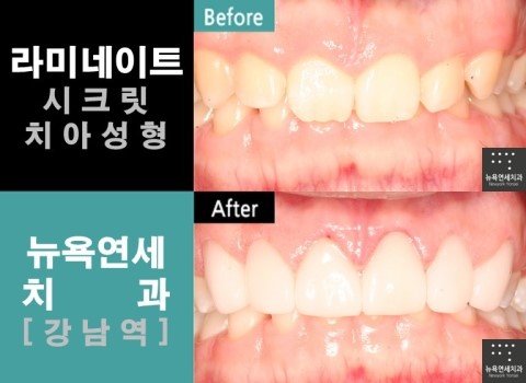  [라미네이트잘하는곳] 치아성형잘하는곳_라미네이트전문