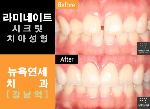 치아성형 vs 치아교정