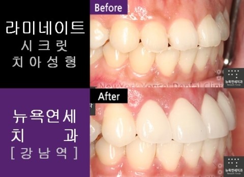  [강남역치과] 앞니라미네이트 잘하는치과_라미네이트 전후사진