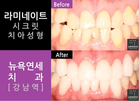  강남역치과 라미네이트 잘하는곳