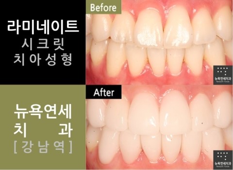  치아성형잘하는곳