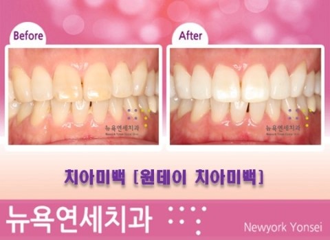  [원데이치아미백 치아미백가격 / 치아미백비용] 줌미백 전후사진