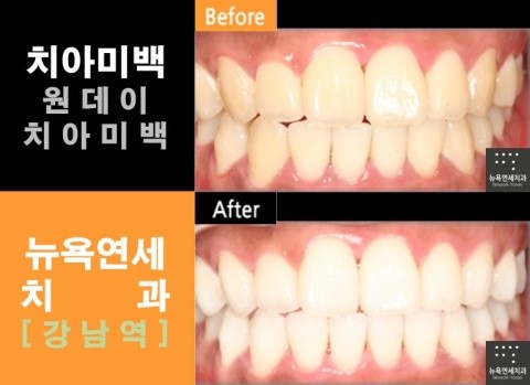  치아미백전문