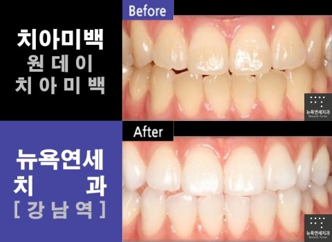  치아미백잘하는곳