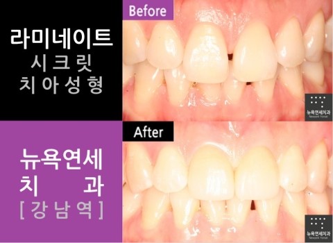  [강남역치과] 합리적인 라미네이트비용