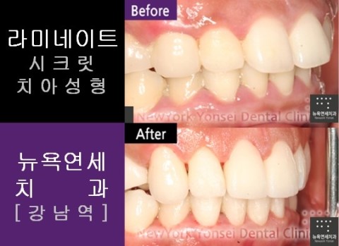  강남역치과, 앞니라미네이트 전문치과_치아성형 전후사진