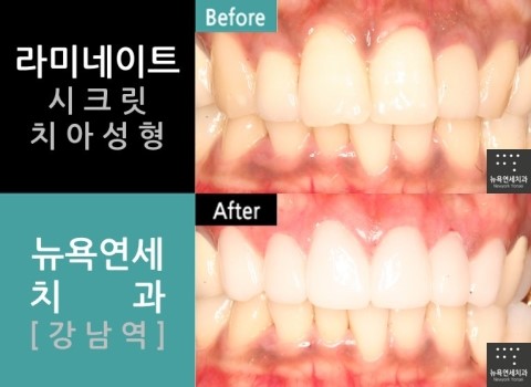  치아성형전문