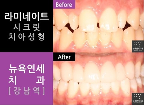  치아성형