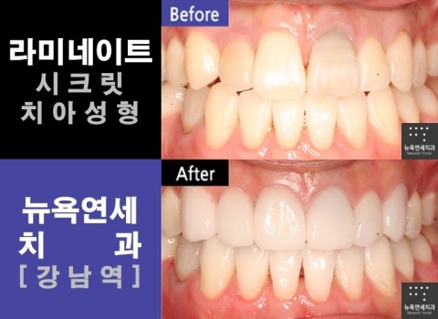  [강남역치과 라미네이트] 앞니라미네이트 잘하는곳