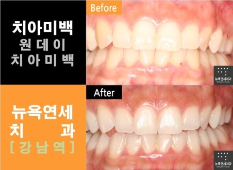  치아미백 비용 # 가격