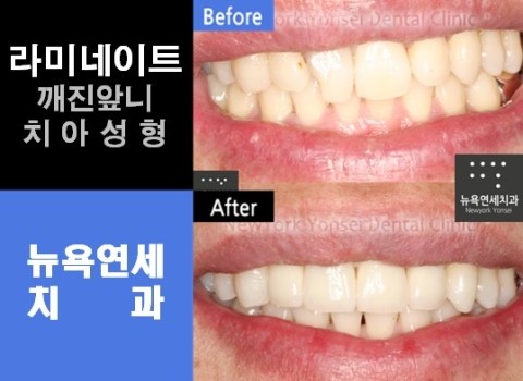  [치아성형] 시크릿 라미네이트 잘하는곳_앞니성형 전후사진