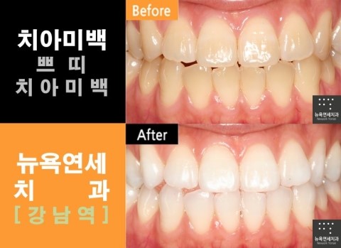  [원데이치아미백] 치아미백잘하는곳