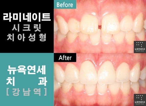  라미네이트잘하는곳/강남역라미네이트