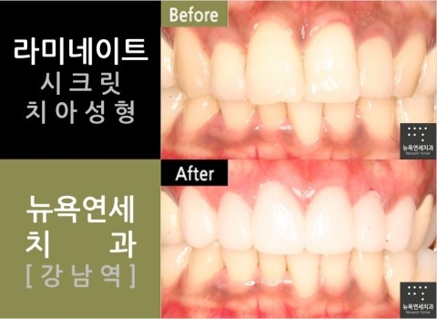  강남역치과 '앞니 치아성형' 잘하는곳