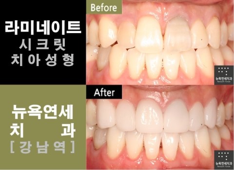  라미네이트, 라미네이트비용, 라미네이트가격