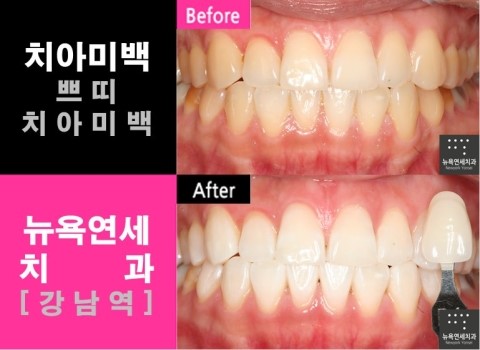  [강남역치과] 원데이치아미백 시술전후