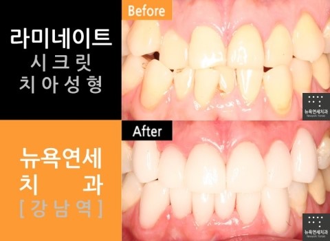  [강남역치과 치아성형] 잘하는곳