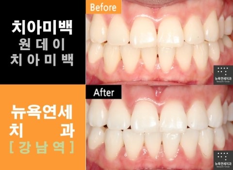  [강남역치과 치아미백] 원데이치아미백