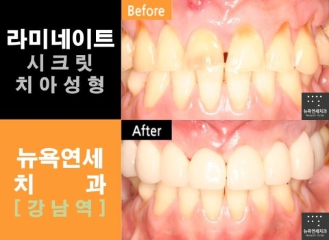  강남역치과, 라미네이트 잘하는곳