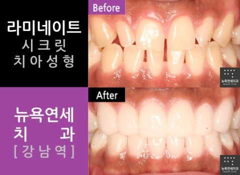  [뉴욕연세치과 Q&A] 벌어진앞니 라미네이트
