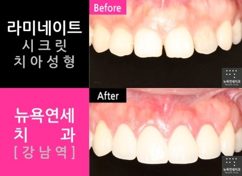  라미네이트부작용 / 라미네이트주의사항