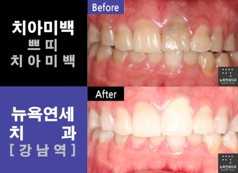 [치아미백Q&A] 치아미백기간, 치아미백가격
