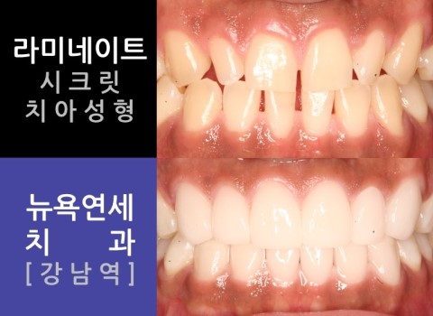  [강남역치과] 치아성형 * 라미네이트 시술전후