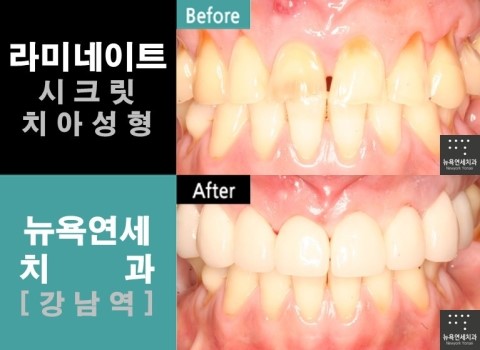  라미네이트 효과 * 시술전후