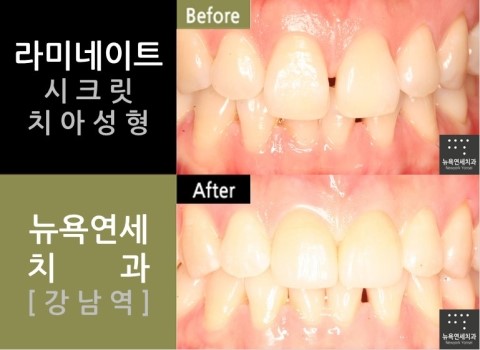  [강남치과] 라미네이트 잘하는곳