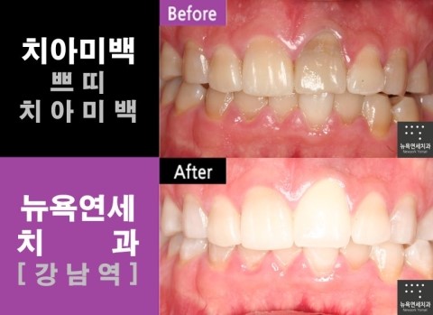  강남역치과 치아미백 시술전후