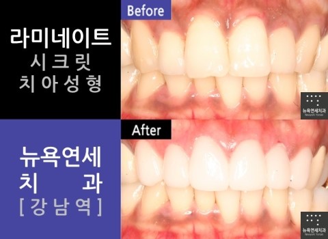 [강남역] 치아성형 전문