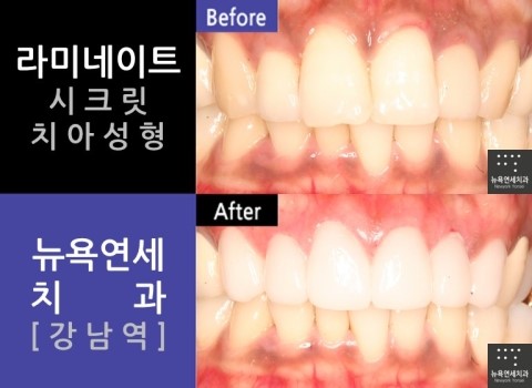  [강남역] 치아성형 전문