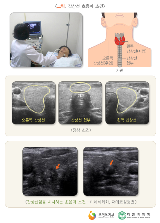 갑상선 미세석회화/세침흡인검사/갑상선유두암/블레스유외과