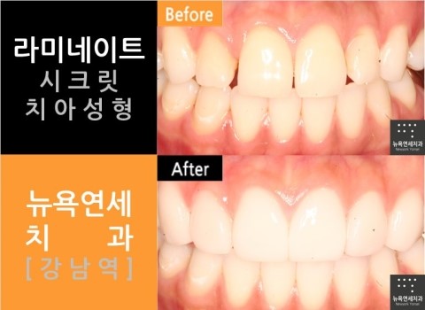  라미네이트 치과