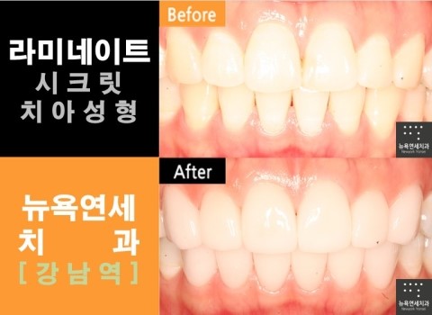  [강남역치과 라미네이트] 라미네이트 잘하는곳