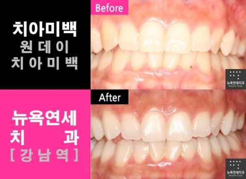 강남역 치과, 치아미백 전문치과
