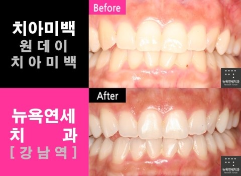  강남역 치과, 치아미백 전문치과