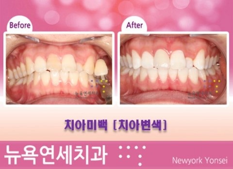  [강남역치과 치아미백] 전문